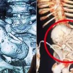 প্রসবের ভয়ে হাসপাতাল থেকে পালিয়েছিলেন, ৩৬ বছর পর পেট থেকে মিলল ‘পাথর শিশু’
