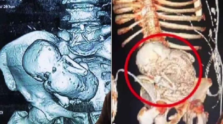 প্রসবের ভয়ে হাসপাতাল থেকে পালিয়েছিলেন, ৩৬ বছর পর পেট থেকে মিলল ‘পাথর শিশু’